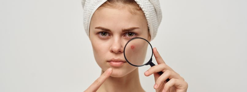 Les meilleures solutions pour lutter contre l'acné